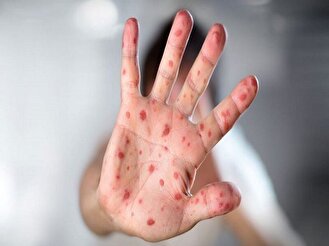 مشاهده سرخک در سه شهرستان فارس