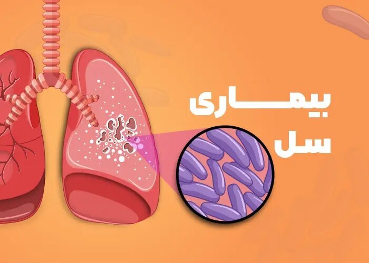 شناسایی ۹۵ بیمار مبتلا به سل در یزد